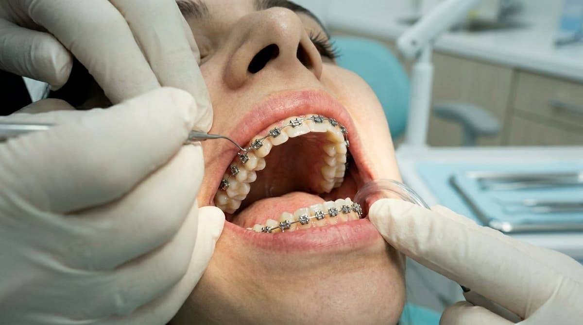 Fixed orthodontic braces treatment by specialist in Dhaka