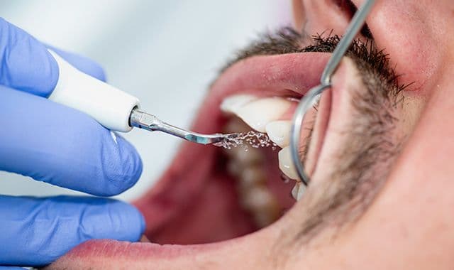 Professional dental scaling and cleaning