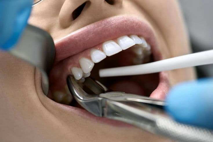 Safe tooth extraction Gulshan Dhaka